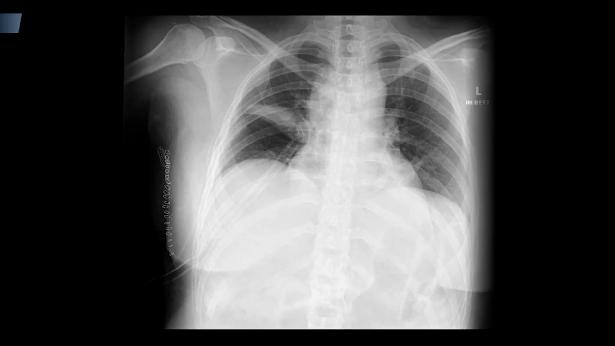 Wieder Fehldiagnose: Gesunder Frau wegen Krebsverdacht Teil der Lunge entfernt